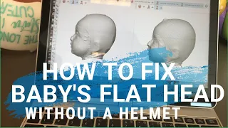 How to fix baby flat head without a helmet or band | easy tips baby flathead