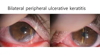 Conjunctival recession and AMT for bilateral peripheral ulcerative keratitis