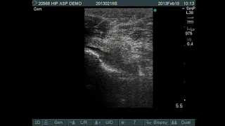 Ultrasound quided hip aspiration