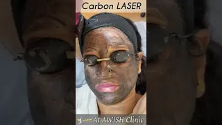 CARBON LASER for hyperpigmentation #shorts #hyperpigmentation #pigmentation #treatment #awishclinic