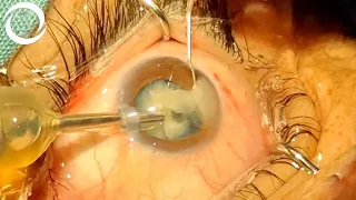 Phaco in a White Cataract (HD)