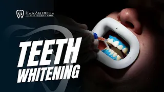 Teeht Whitening!