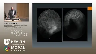 "Roid Rage": Intermediate Uveitis