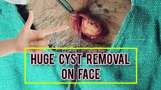 Large cyst removal with comedones (blackheads and whiteheads) on face | #Dr.AMAZINGSKIN