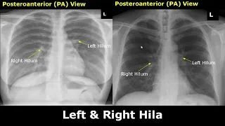 Normal Chest X-Ray Labelled Anatomy PA View Part 1: CXR Interpretation| Ribs/Heart/Lungs Radiography