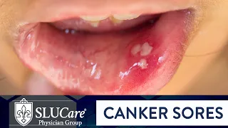 Determining Causes & Treatment for Canker Sores - SLUCare Otolaryngology