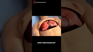 Heart Lung transplant 3D video _ 2nd Part _ #shorts