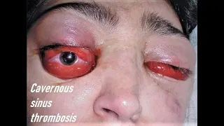 How to Diagnose Cavernous Sinus Thrombosis | 'All you need to know' points for Management