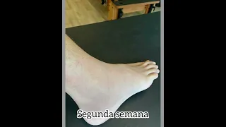 Como tratei minha lesão de 3 ligamentos do tornozelo -Não precisando de cirurgia