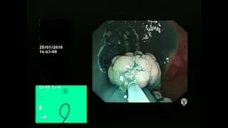 Piecemeal EMR of large caecal polyp (LST-G) and clipping