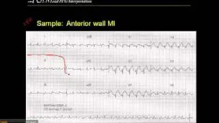 12-15 Lead ECG: Sample Anterior Wall MI