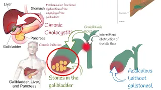 Cholecystitis Signs and symptoms.   Chronic and acute Cholecystitis, biliary colic