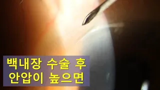 [백내장] 수술 후 안압이 높으면... Aqueous tap for elevated IOL after cataract surgery.