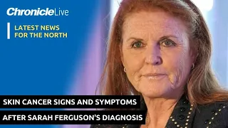 Skin cancer signs and symptoms - how to spot a malignant melanoma after Sarah Ferguson's diagnosis