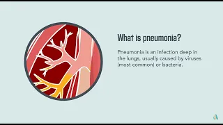 Pneumonia: Symptoms, Diagnosis, Treatment, and Prevention | Merck Manual Consumer Version