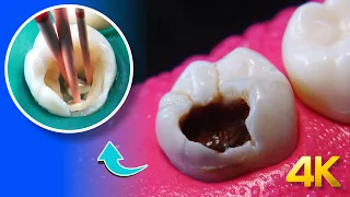 AMAZING restoration of tooth with extensive cavity: RCT in 4K