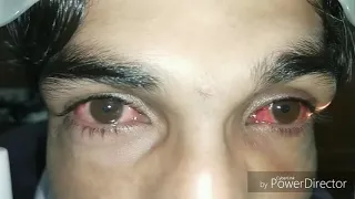 Adenoviral Conjunctivitis