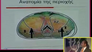 Χειρουργικά μυστικά: Βιοψία προστάτου - How to do it | Αδαμόπουλος