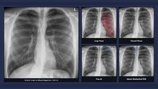 Simple Pneumothorax: Explanation of Chest X-ray Findings