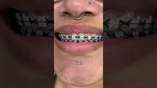 Best Braces Colors for Black Hair