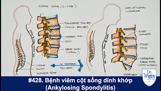 #428. Đau lưng ở người trẻ: Bệnh viêm cột sống dính khớp (Ankylosing spondylitis)