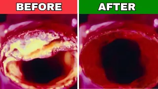 What MEN Need To Eat to Clean Clogged Arteries & Prevent Heart Attack