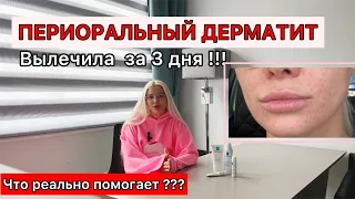 ПЕРИОРАЛЬНЫЙ ДЕРМАТИТ ЧЕМ ЛЕЧИТЬ. ДЕРМАТИТ У ВЗРОСЛЫХ.