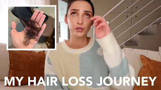 MY HAIR LOSS JOURNEY | SIGNS OF HAIR LOSS | ANDROGENIC ALOPECIA | FEMALE HAIR LOSS JOURNEY