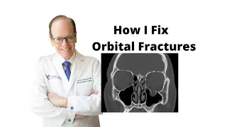 Orbital Fractures 101 | Oculoplastic Surgeon Explains Orbital Fracture Surgery