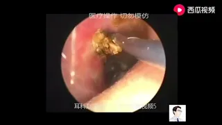 Cleaning Up Cerumen, Massive Ear Wax Removal Extractions of Dry Earwax from Entire Ear Canal #501