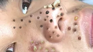 Blackhead Removal With Sac Dep Spa @10009