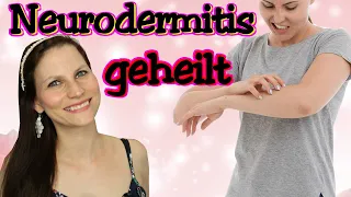 NEURODERMITIS | ICH BIN GEHEILT | EURE FRAGEN BEANTWORTEN