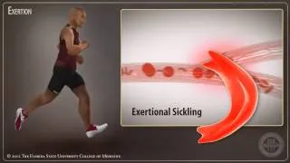 Sickle Cell Trait- Exertional Sickling in Athletes