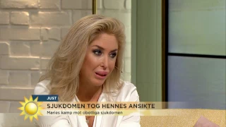 Sjukdomen tog hennes ansikte - Nyhetsmorgon (TV4)