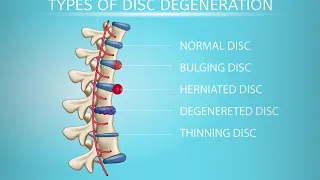 Types of Disc Herniation