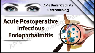 Acute Postoperative Infectious Endophthalmitis | AP'S Undergraduate Ophthalmology