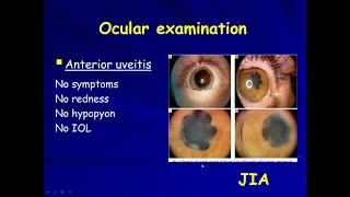 How to approach a case of pediatric uveitis by Dr. Zeinab Turkey