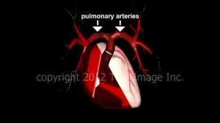 Saddle embolus pulmonary embolism video - Animation by Cal Shipley, M.D.