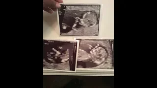 After 3 Losses: First Maternal Fetal Medicine Appt, Ultrasound Photos, Sharing Stories