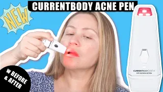CURRENTBODY SKIN ANTI-ACNE LED PEN | How to get rid of acne #ledlighttherapy #acne