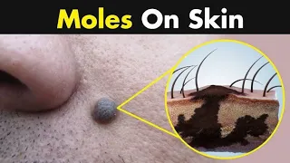 What Causes Moles On Our Skin 3D Animation