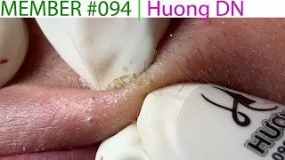 Acne Treatment Huong Da Nang# 094 |  Member | Huong