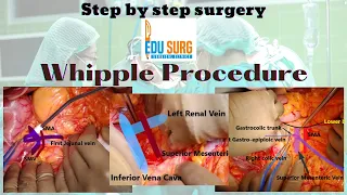 Step by step pancreatic cancer surgery I Whipple procedure I Pancreaticoduodenectomy