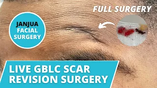 SCAR REVISION SURGERY ON FOREHEAD SCAR - DR. TANVEER JANJUA - NEW JERSEY