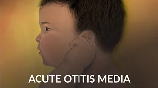 "Acute Otitis Media" by Alex Ruan and Jennifer Cheng
