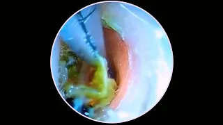 Relaxing Ear Wax Removal Very SATISFYING #151