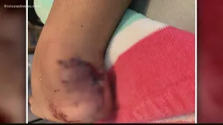 Shark bites 16-year-old girl in Amelia Island Friday morning