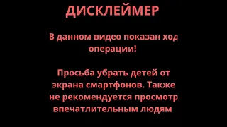 Хирургическая манипуляция