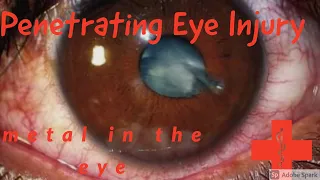 Case Discussion: Penetrating Eye Injury