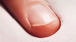 Fingernail growth timelapse